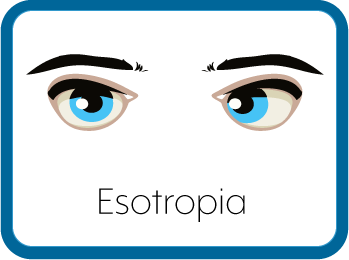Esotropia Eyes Graphic