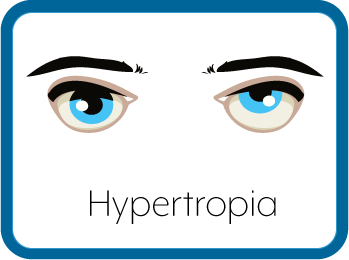 Hypertropia Eyes Graphic