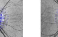 Example of lesioncustomized grids - vvp vivid vision perimetry angioscotoma scotoma lesion high resolution