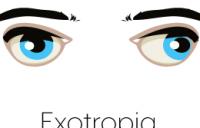 Exotropia Eyes Graphic - exotropia amblyopia strabismus vergence disorders exotropia divergence excess strabismic refractive esotropia exotropia